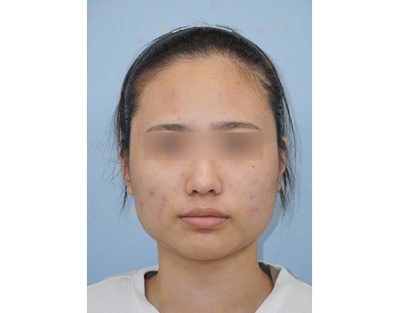 Young person with facial acne.