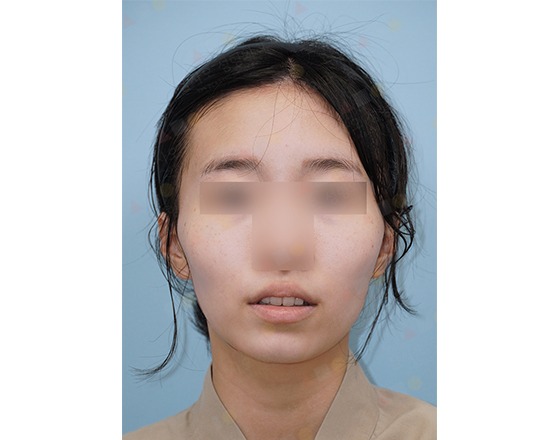 Person with blurred eyes and nose on blue background.