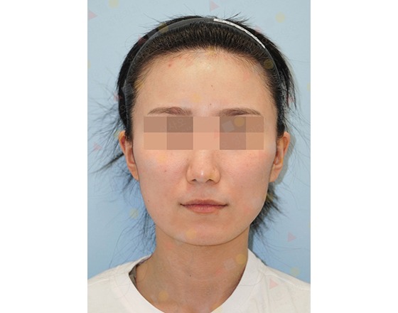 Person with headband and pixelated eyes