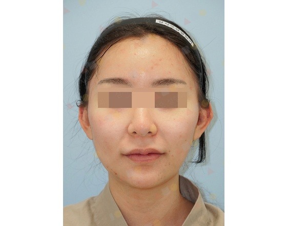 Person with blurred eyes, neutral expression