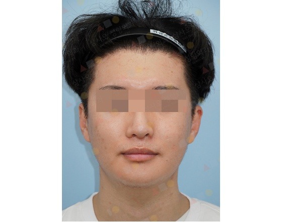 Person with blurred eyes wearing a hairband.