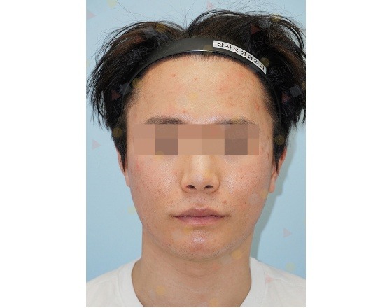 Person with acne wearing headband, blurred face visible.