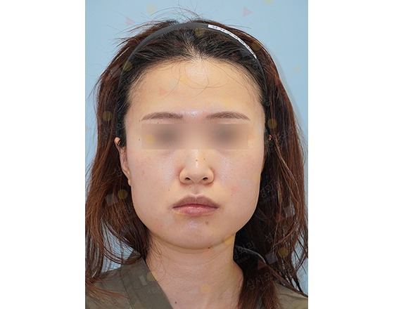 Portrait of woman with blurred eyes, neutral expression.
