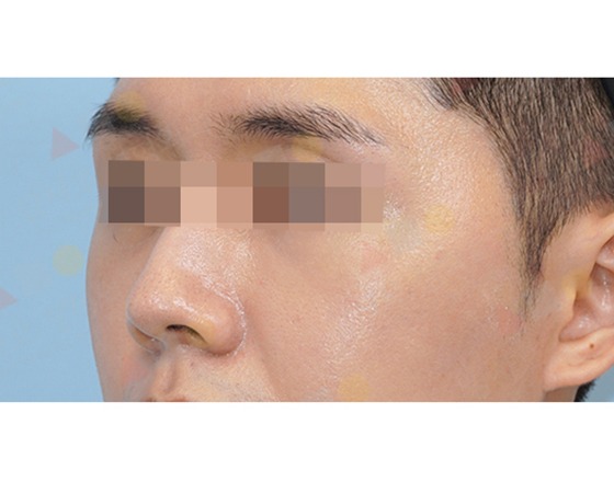 Close-up of a person's face with blurred eyes.