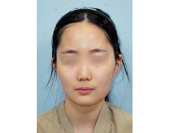 Portrait of a person with blurred eyes.