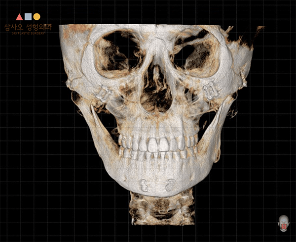 Detailed 3D skull scan with grid background.