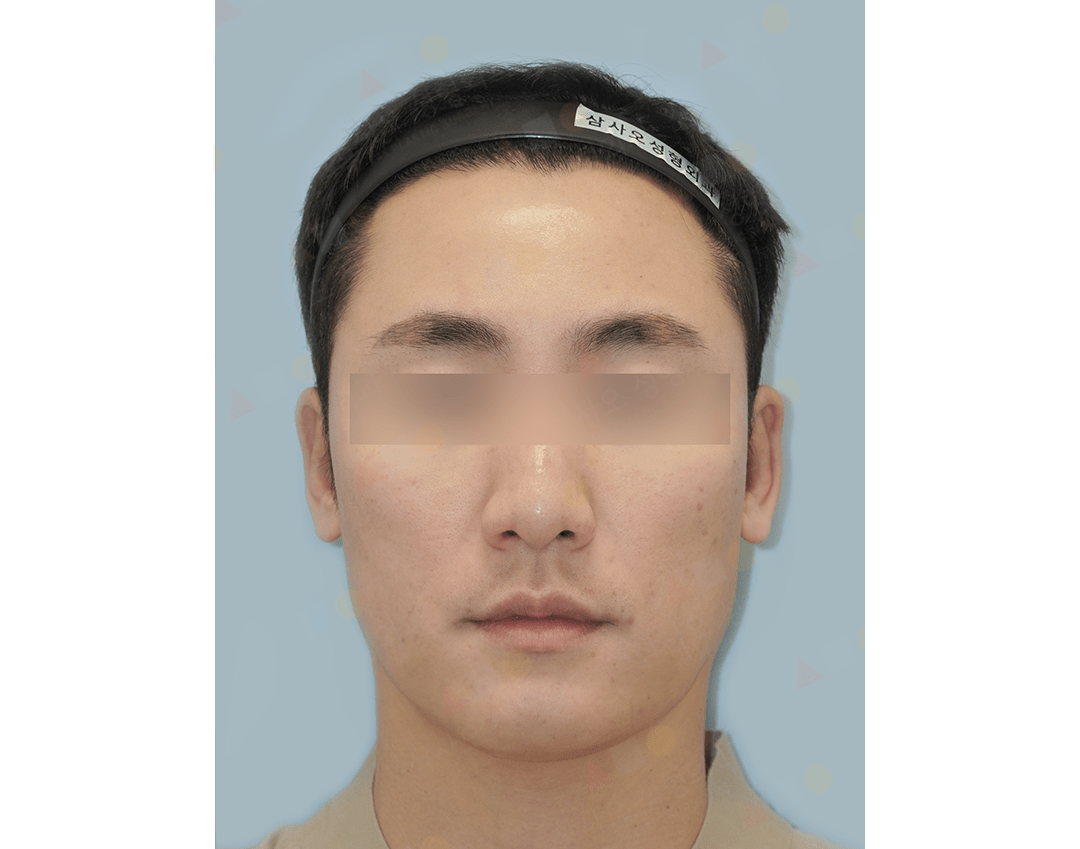 Blurry-eyed person wearing a headband, neutral expression.