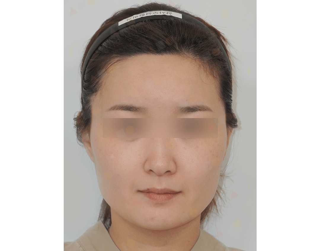 Person wearing headband, blurred eyes, neutral expression