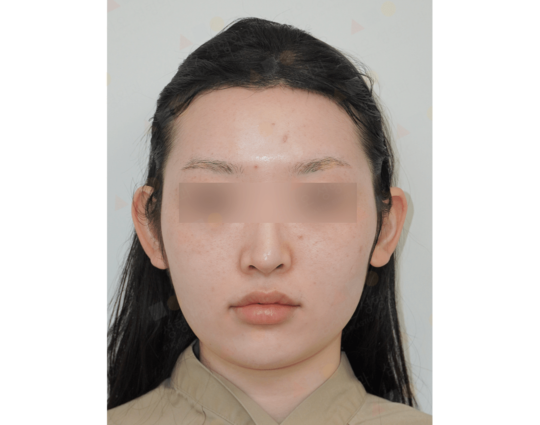 Person with facial blemishes, skin imperfections visible.