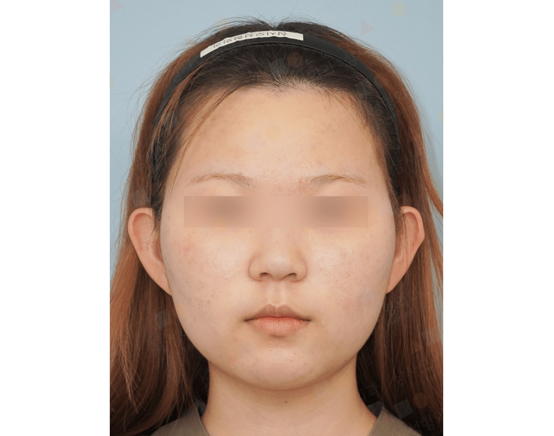 Person with blurred eyes and headband facing forward.
