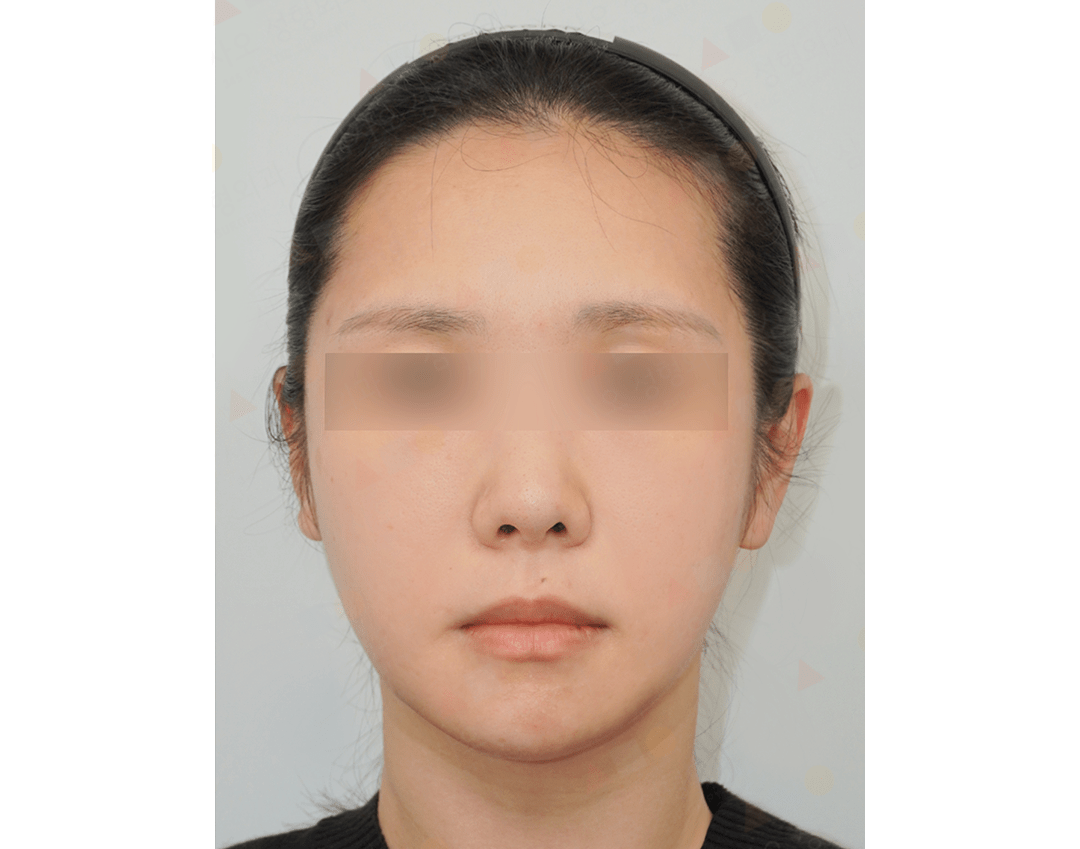 Person with blurred eyes and neutral expression.