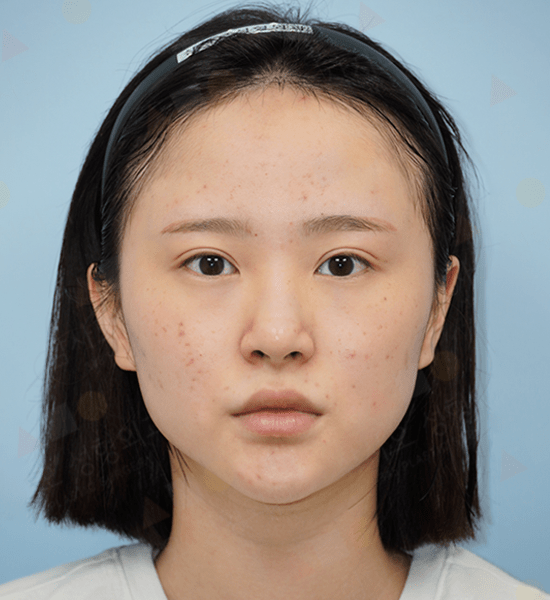 Young person with acne and headband.
