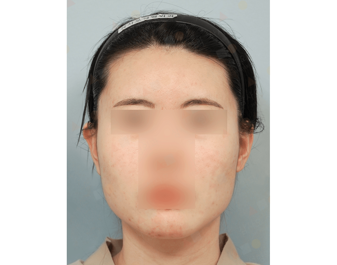 Person with skin blemishes and hairband.