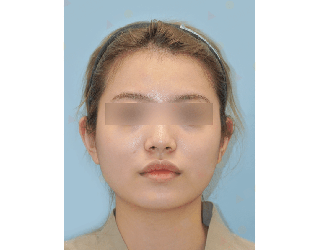 Front view of person with neutral expression.