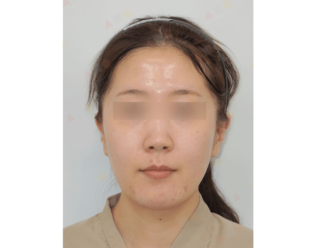 Person with blurred eyes, neutral expression.