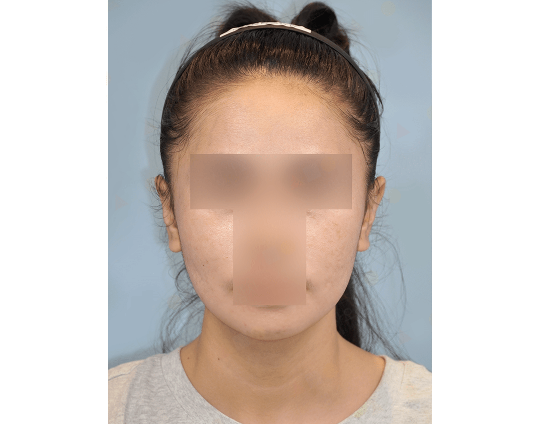 Blurred face with headband, front view.