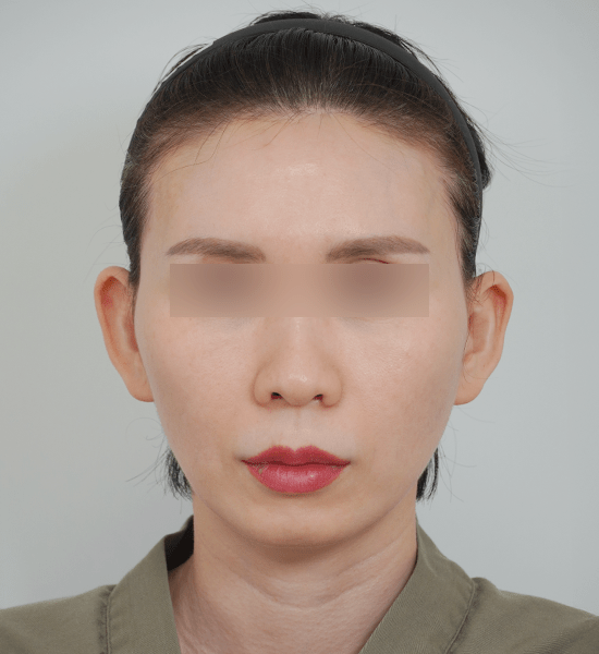 Person with blurred eyes and neutral expression.