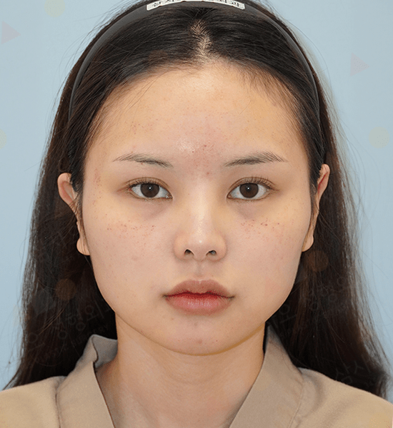 Woman with facial blemishes and neutral expression.